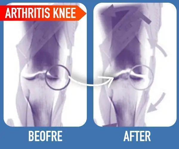 Joint Arthritis Patch