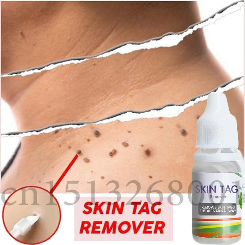 12-Hour Skin Tag Remover