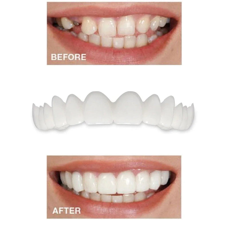 Instant Perfect Smile Dental Veneers