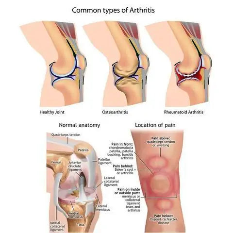 Joint Arthritis Patch