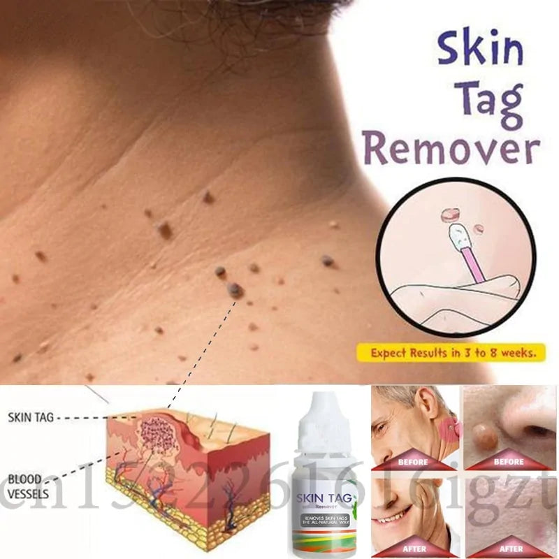 12-Hour Skin Tag Remover