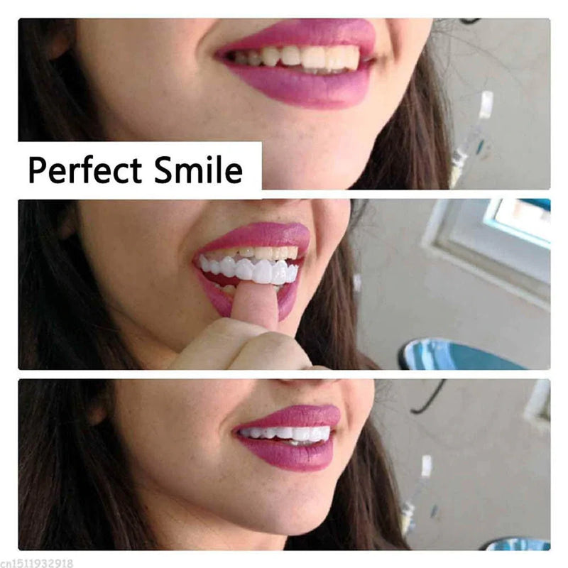 Instant Perfect Smile Dental Veneers